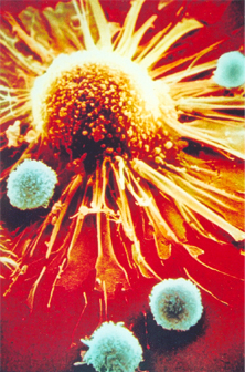 Linfócitos T-CD8 (azul) atacando uma célula tumoral (amarela) 