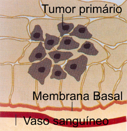 Formação do tumor primário geralmente próximo a algum vaso sanguíneo.