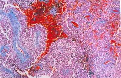 Invasão de células tumorais (vermelho) no tecido hepático. As células tumorais chegam por meio de vasos sanguíneos do tecido hepático e se acomodam, dando início à progressão tumoral.