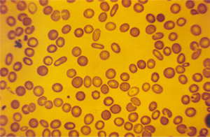 Discreta anisocitose e poiquilocitose com leptócitos e esferócitos em anemia hemolítica da malária. Esse paciente apresentou VCM e HCM normais apesar de várias hemácias estarem morfologicamente alteradas.