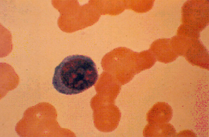 Figura 2: Empilhamento de hemácias (roleaux) e um plasmócito em paciente com mieloma múltiplo. A anemia era discreta (Hb: 10,5g/dL) com VCM e HCM normais.