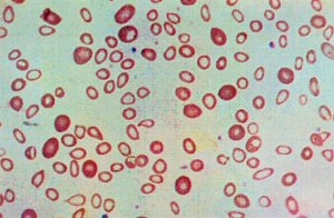 Figura 4: Anemia microcítica e hipocrômica na ferropenia grave.