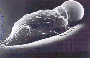 Figura 7: Um esferócito é fagocitado por macrófago no sistema reticulo-endotelial do baço. Microscopia eletrônica de varredura obtida pelo Prof. Marcel Bessis.