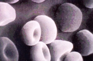 Figura 9: Microscopia eletrônica de esferócitos juntos com alguns eritrócitos normais de sangue coletado de paciente com anemia esferocítica.