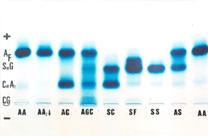 Figura 10: Eletroforese alcalina em gel de agarose com muitas hemoglobinas variantes, entre elas os genótipos de Hb AS, SF, SS e SC, os três últimos agrupados como doença falciforme.