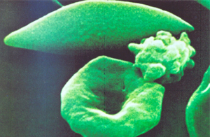 Figura 11: Microscopia eletrônica de varredura de eritrócitos falcizados em comparação com outro discóide.