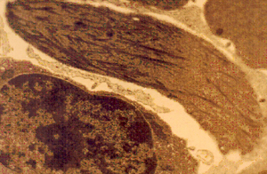 Figura 12: Microscopia eletrônica plana de eritrócito falcizado onde é possível observar inúmeros polímeros de agregados moleculares de Hb S desoxigenada, dispostos longitudinalmente na célula afoiçada.