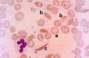 Figura 13: Microscopia óptica de sangue com anemia falciforme (Hb SS). (a) eritrócito com Hb S oxigenada com a forma discóide; (b) duas situações que representam a fase inicial da falcização; (c) eritrócito falciforme irreversível.