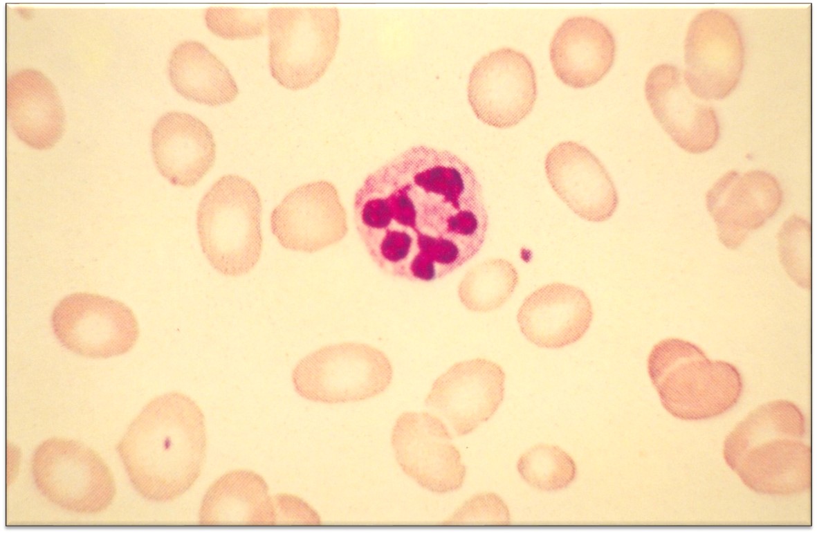 Hemograma_anemia